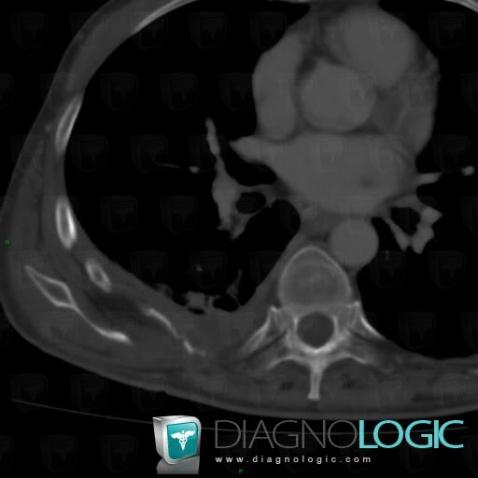 Gorham’s disease, Ribs, CT