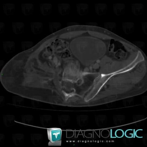 Gorham’s disease, Sacrum / Coccyx, CT