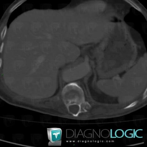 Gorham’s disease, Vertebral body / Disk, CT