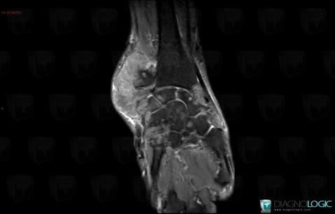 Gout, Mediocarpal joint, MRI