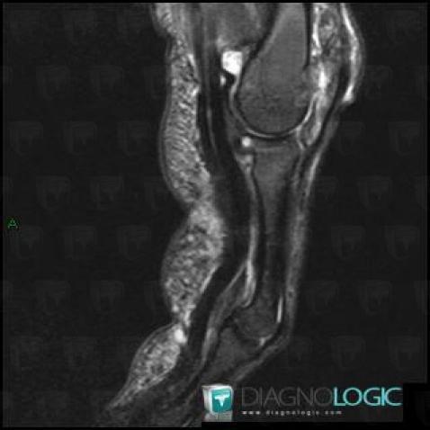 Gout, Metacarpophalangeal joints, MRI