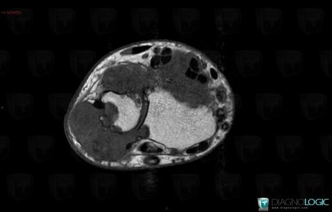 Gout, Radius - Distal part, MRI