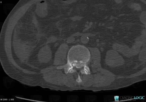 Gout, Spinal canal / Cord, CT