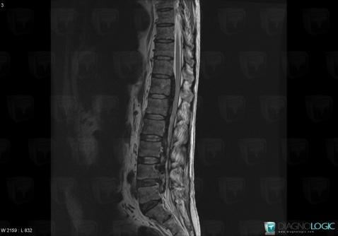 Gout, Spinal canal / Cord, MRI