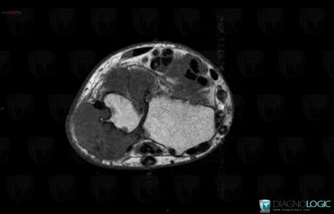 Gout, Ulna - Distal part, MRI