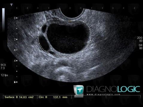 Radiology case : Graafian follicle (US) - Diagnologic