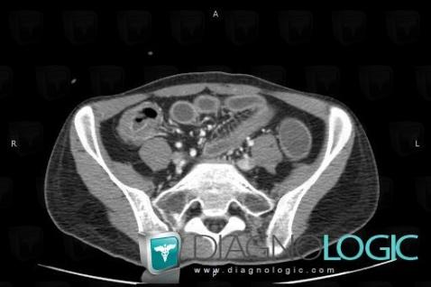 Graft-versus-host disease, Colon, CT