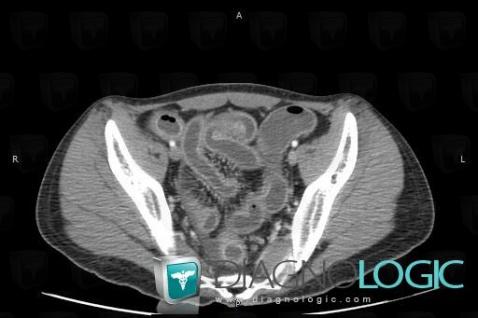 Graft-versus-host disease, Small bowel, CT