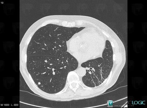 Granuloma, Pulmonary parenchyma, CT