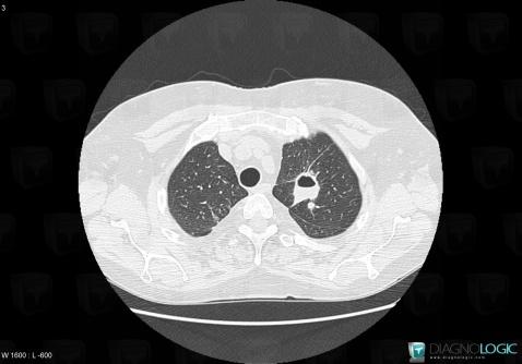 Granulomatose-Wegener, Parenchyme pulmonaire, Scanner