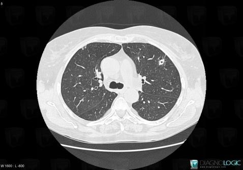 Granulomatose-Wegener, Parenchyme pulmonaire, Scanner