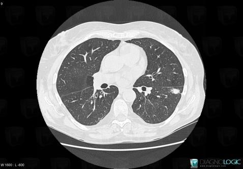 Granulomatose-Wegener, Parenchyme pulmonaire, Scanner