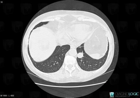 Granulomatose-Wegener, Parenchyme pulmonaire, Scanner