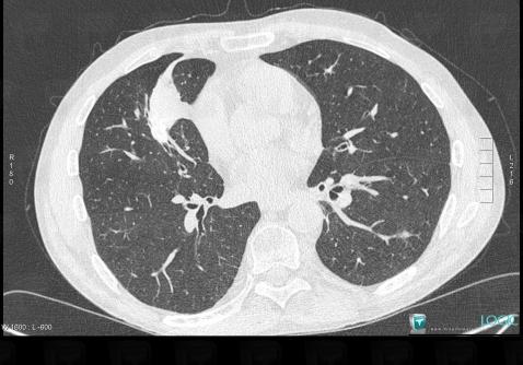 Granulomatose-Wegener, Parenchyme pulmonaire, Scanner