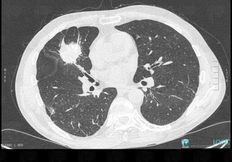 Granulomatose-Wegener, Parenchyme pulmonaire, Scanner