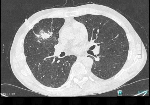 Granulomatose-Wegener, Parenchyme pulmonaire, Scanner