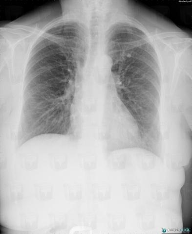 Granulome , Parenchyme pulmonaire, Radio