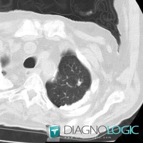 Granulome , Parenchyme pulmonaire, Scanner