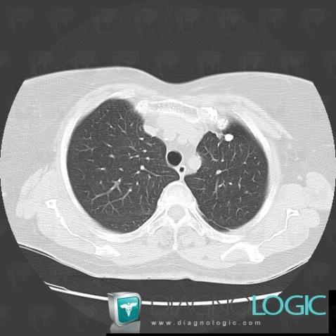 Granulome , Parenchyme pulmonaire, Scanner