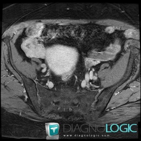 Granulosa cell tumor, Adnexa / Ovary fallopian tube, MRI