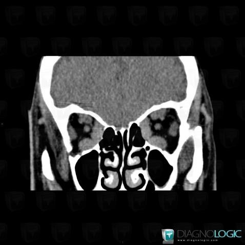 Graves’ disease, Eye, CT