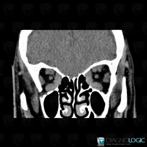 Graves’ disease, Eye, CT