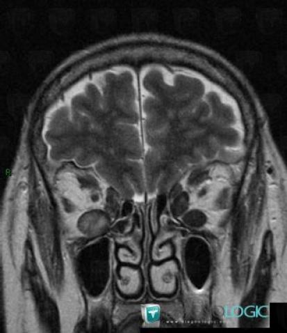 Graves’ disease, Eye, MRI