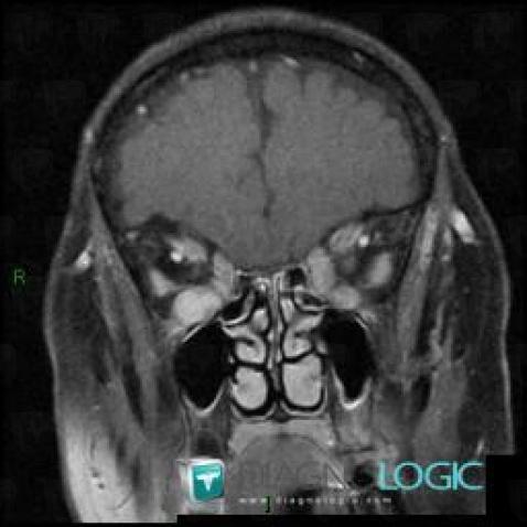 Graves’ disease, Eye, MRI