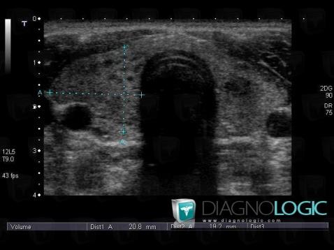 Radiology case : Graves’ disease (US) - Diagnologic