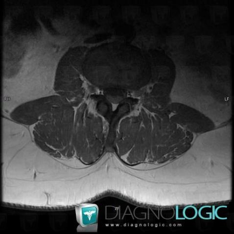 Guillain-Barré syndrome, Spinal canal / Cord, MRI