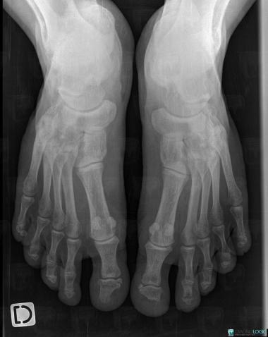 Hajdu-Cheney Syndrome, Phalanx / Sesamoid bones - Foot, X rays
