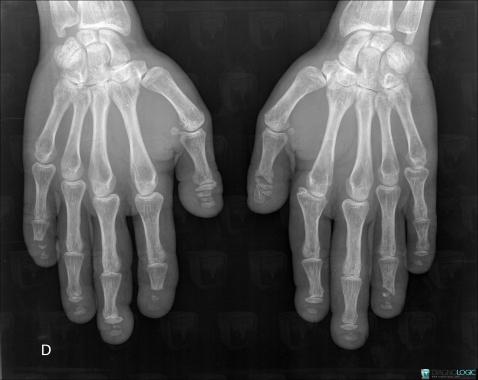 Hajdu-Cheney Syndrome, Phalanx / Sesamoid bones - Hand, Thumb, X rays