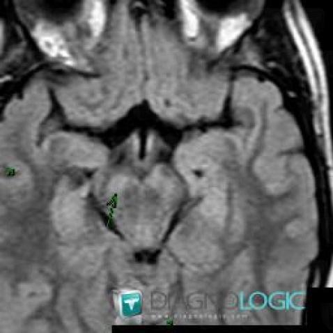 Hamartoma, Brainstem, Posterior fossa, MRI