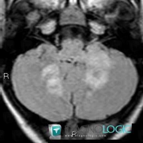 Hamartoma, Cerebellar hemisphere, MRI