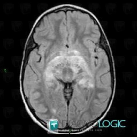 Hamartoma, Cerebral hemispheres, Ventricles / Periventricular region, MRI