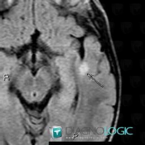 Hamartoma, Cortico subcortical region, MRI