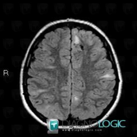 Hamartoma, Cortico subcortical region, MRI