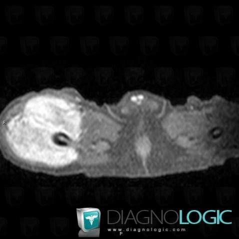 Hamartoma, Muscles - Thigh, Other soft tissues/nerves - Thigh, MRI