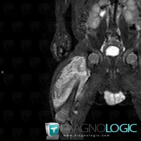 Hamartoma, Muscles - Thigh, Other soft tissues/nerves - Thigh, MRI