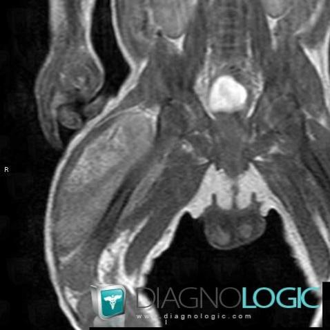 Hamartoma, Muscles - Thigh, Other soft tissues/nerves - Thigh, MRI