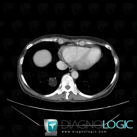 Hamartoma, Pulmonary parenchyma, CT