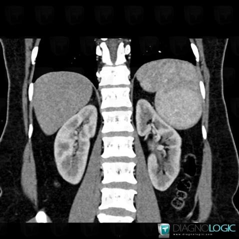 Hamartoma, Spleen, CT