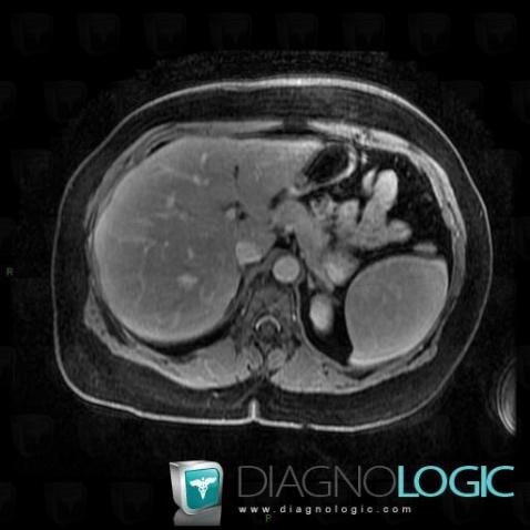 Hamartoma, Spleen, MRI