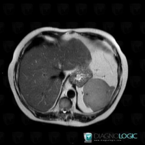 Hamartoma, Spleen, MRI