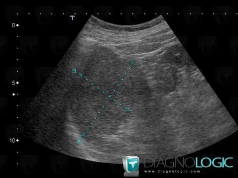 Hamartoma, Spleen, US