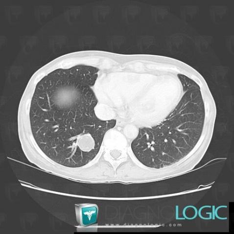 Hamartome, Parenchyme pulmonaire, Scanner