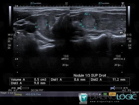 Hashimoto's thyroiditis, Thyroid / Parathyroid, US