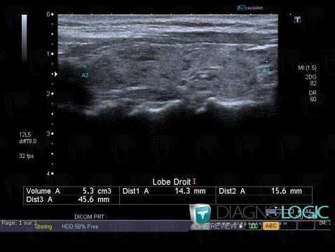 Hashimoto's thyroiditis, Thyroid / Parathyroid, US