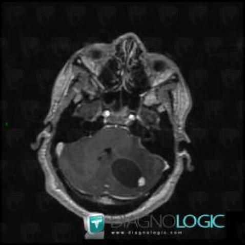 Hemangioblastoma, Cerebellar hemisphere, Posterior fossa, MRI