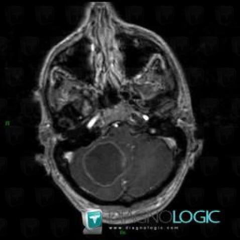 Hemangioblastoma, Cerebellar hemisphere, Posterior fossa, MRI
